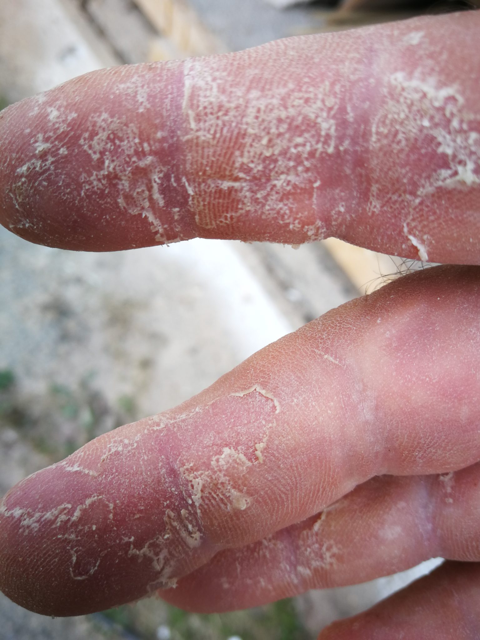 Trouble with hands and other problems at the Epoxy Ltd